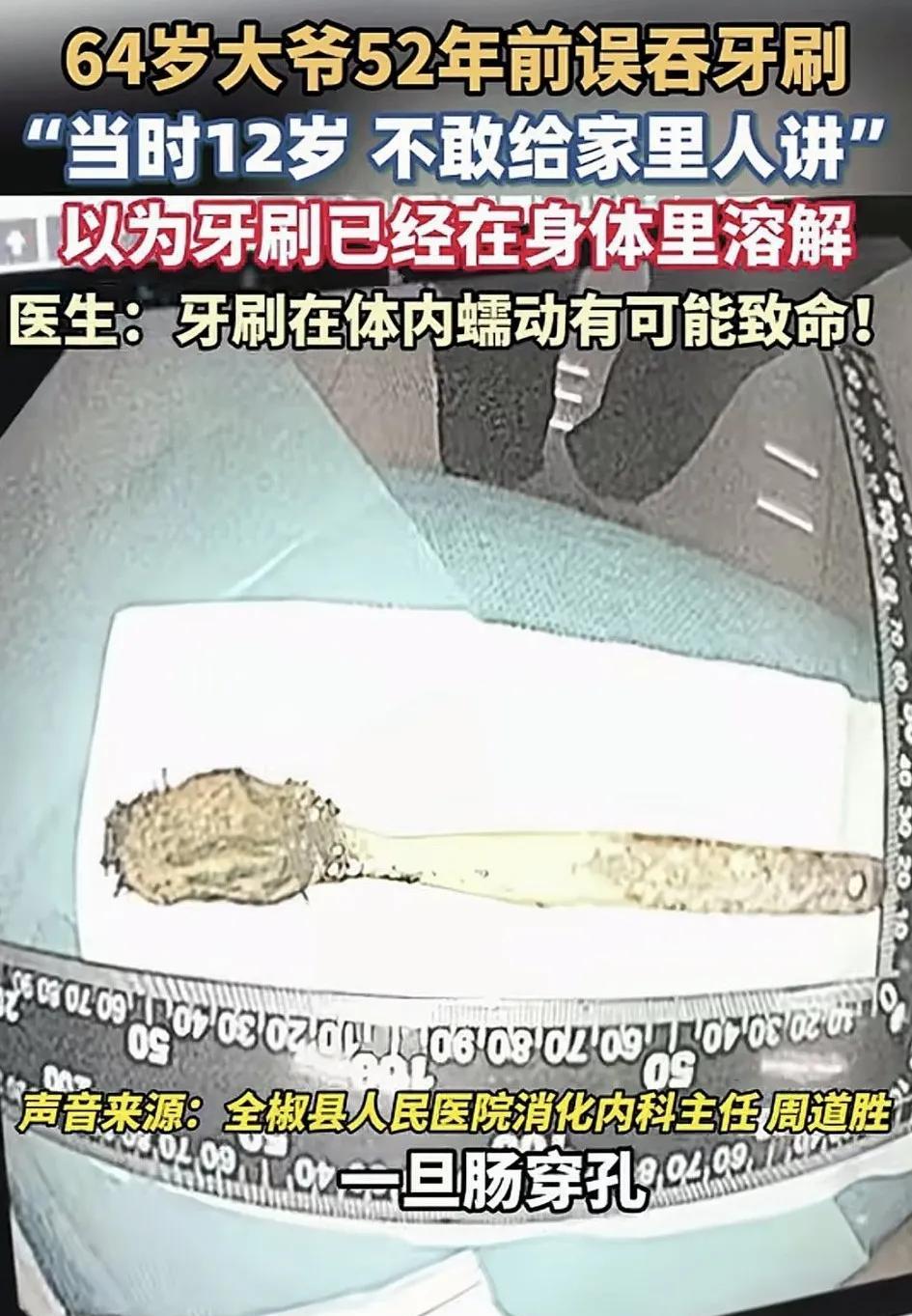 安徽，一64岁大爷因胸痛到医院就医，结果医生一番检查下来，竟从大爷肠道内发现一个