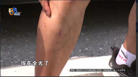 浙江诸暨，男子开新能源车1年，突然发现自己两条腿上原本茂密的毛发，竟然都掉秃了，