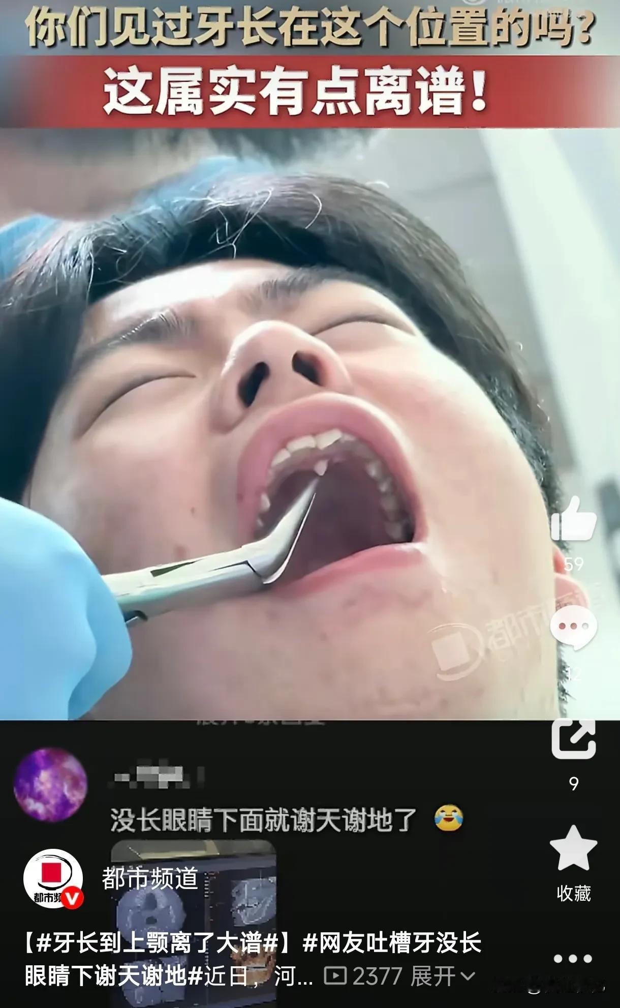 笑不活了！河北，一小伙因为牙疼去牙科拔牙，结果医生检查时发现，他的牙齿竟然长在了
