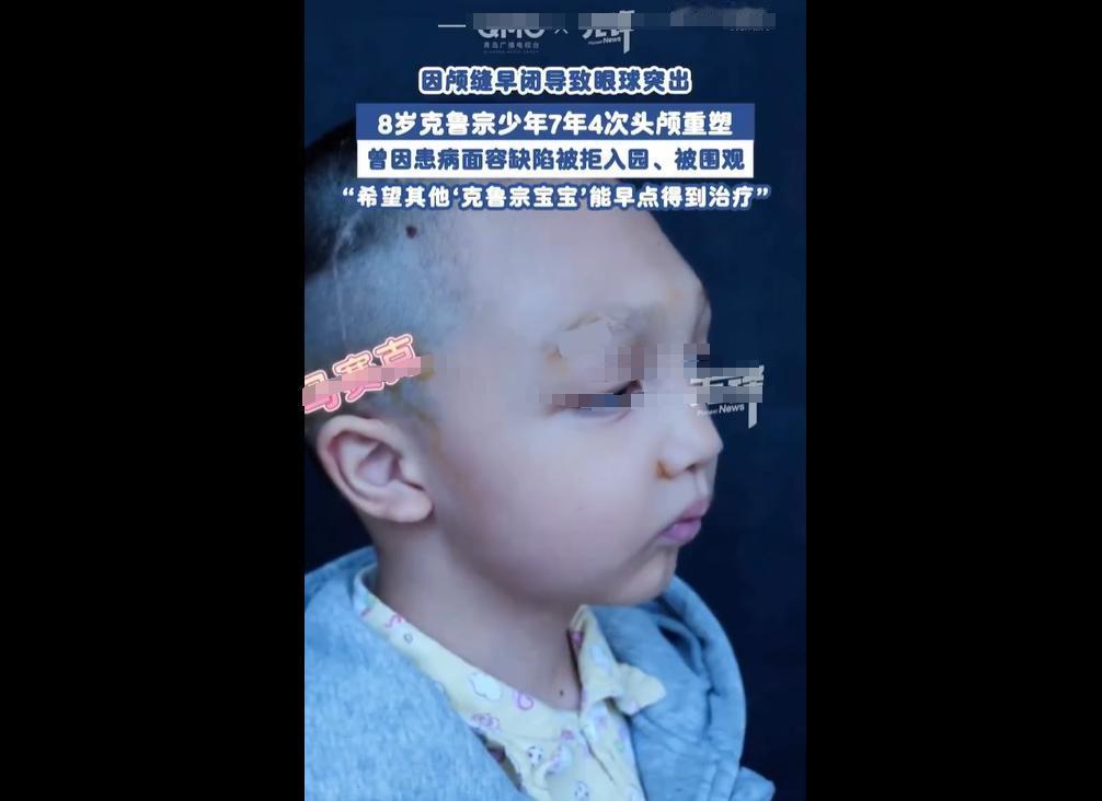 上海8岁男孩患罕见的克鲁宗综合征，因基因突变致颅缝早闭、眼球突出，遭幼儿园拒