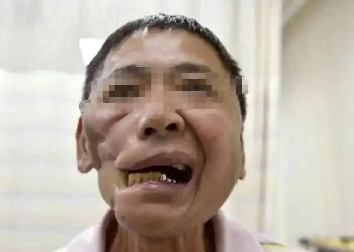 12月26日，湖南省常德市一36岁男子因长期嚼槟榔患上口腔癌，住院治疗一个多月了