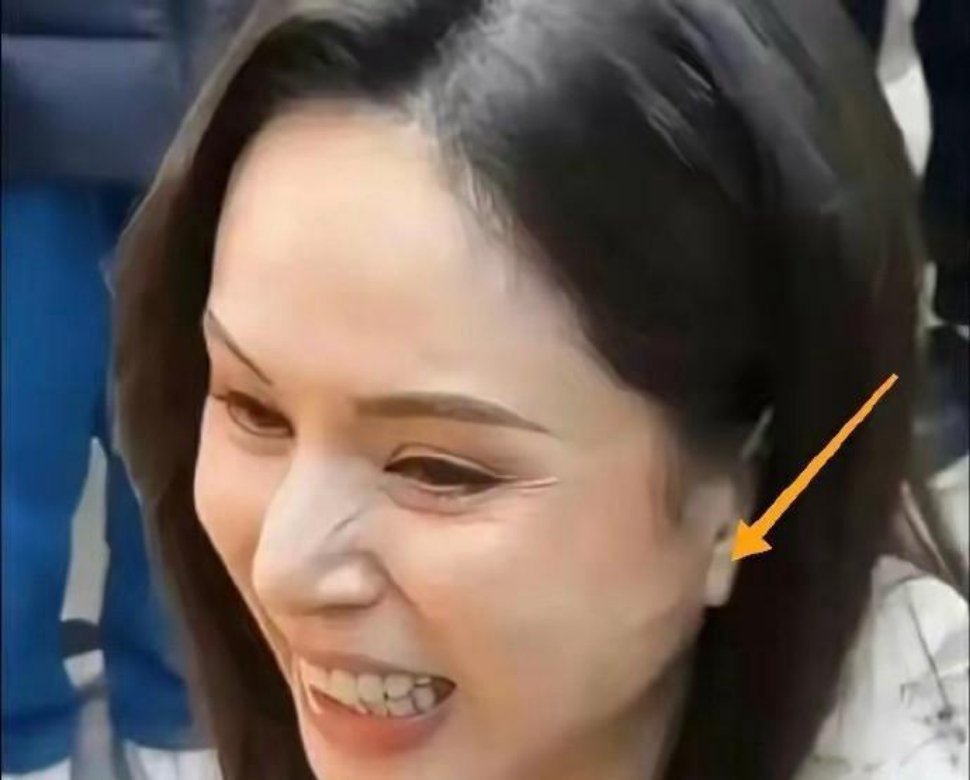 搞不懂了，李若彤不是没有医美过吗？这耳前凸起的一条线是啥