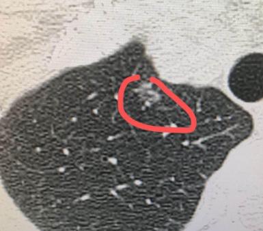 命运有时候很残酷，但还是会留一扇窗！刘先生查出肺癌时已经是晚期了。其实早几年他就