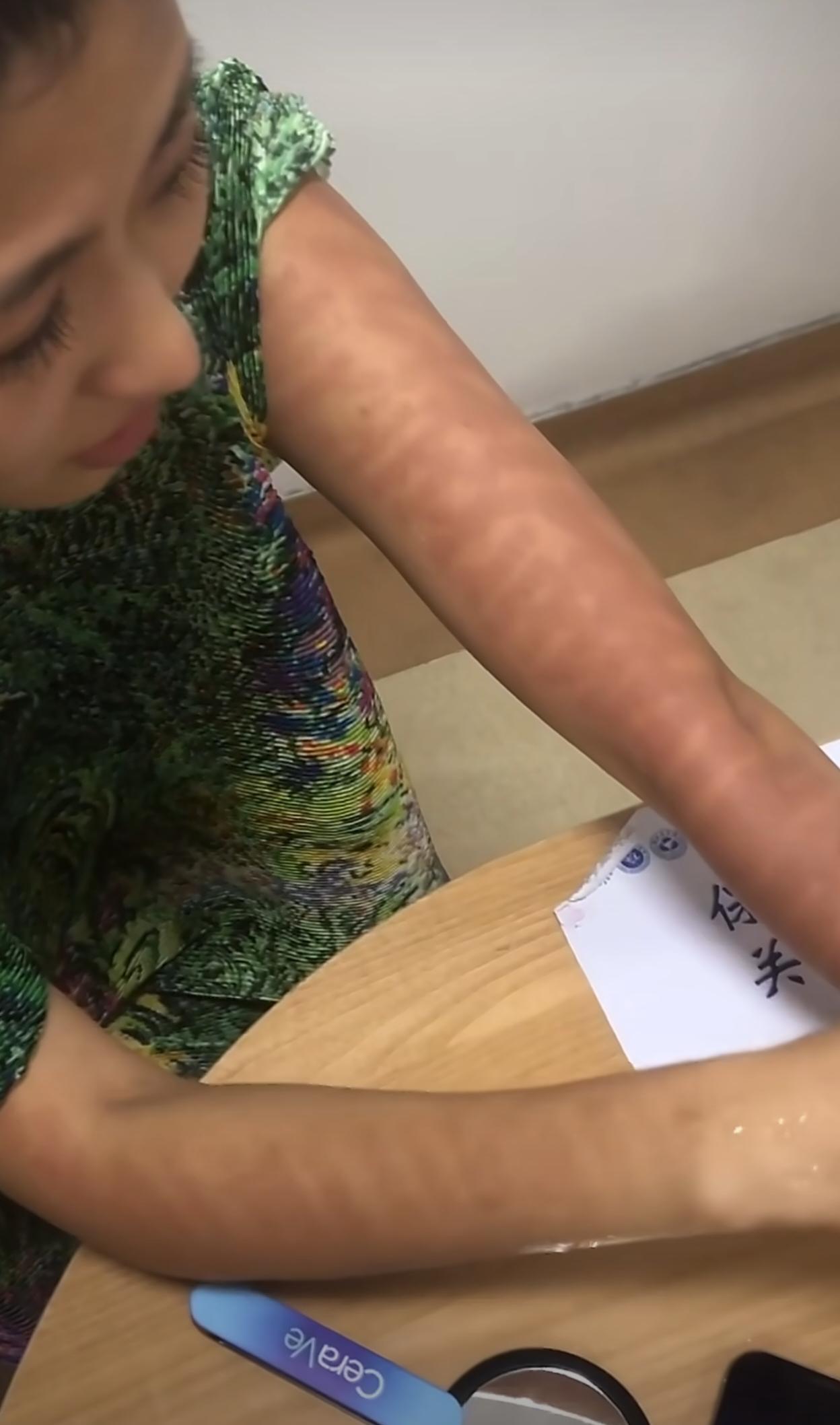 网红千里寻椰去医美机构给手打光子嫩肤，打完之后手开始火辣辣的疼持续了七个小时，去