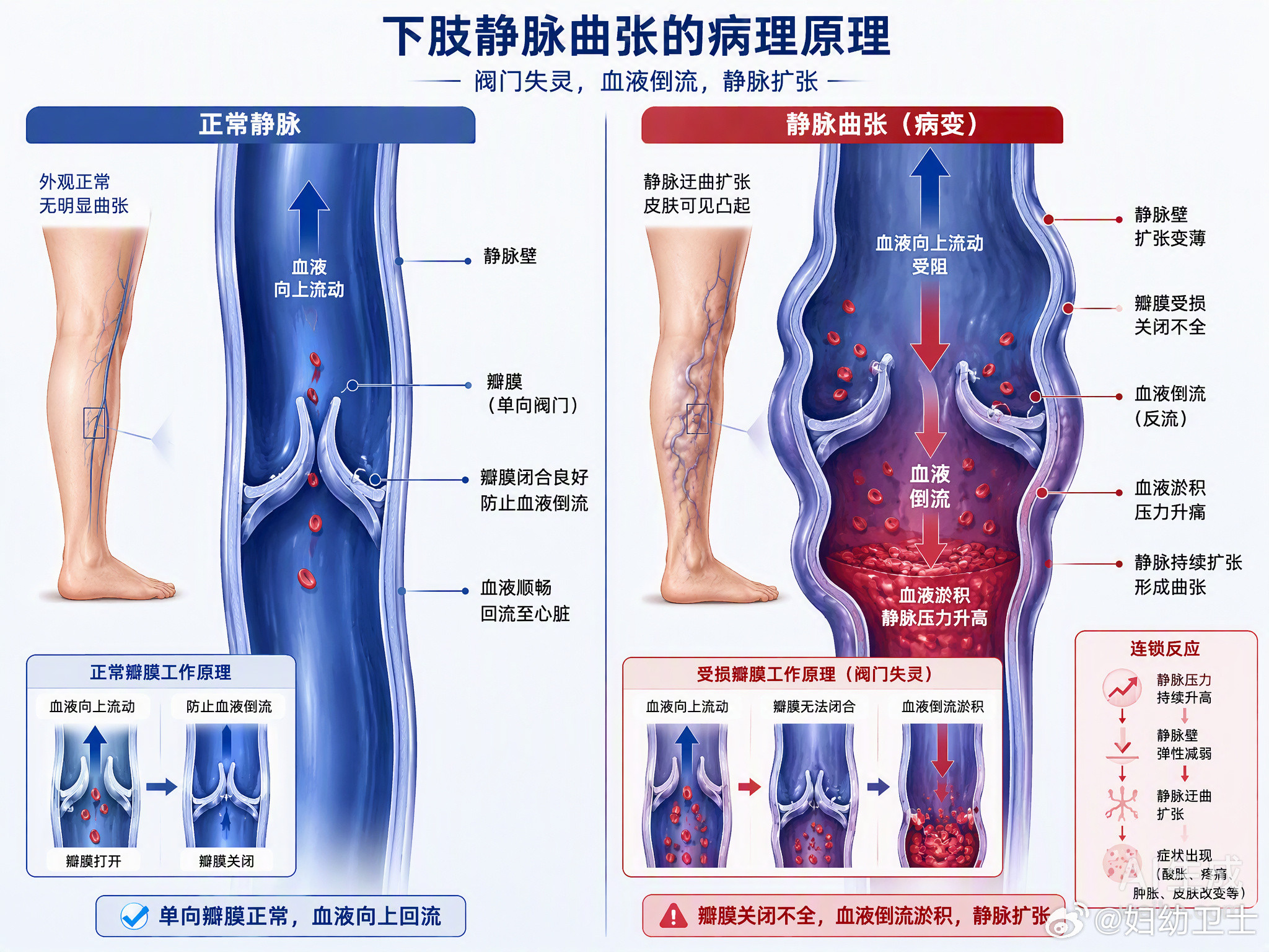 腿上那几根“蚯蚓”不痛不痒，很多人就真以为只是美观问题。南京李阿姨拖了8年，从青筋凸起熬到皮肤发黑、