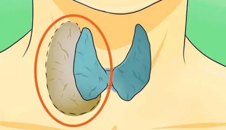 硬核研究所【良性甲状腺结节基本不会转恶】甲状腺癌是否需要切除发表在《柳叶刀·