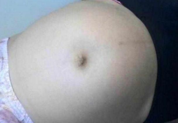 孕妇医院生孩子, 却被医生切了胃, 孕妇大哭, 家人知道后跪谢医生