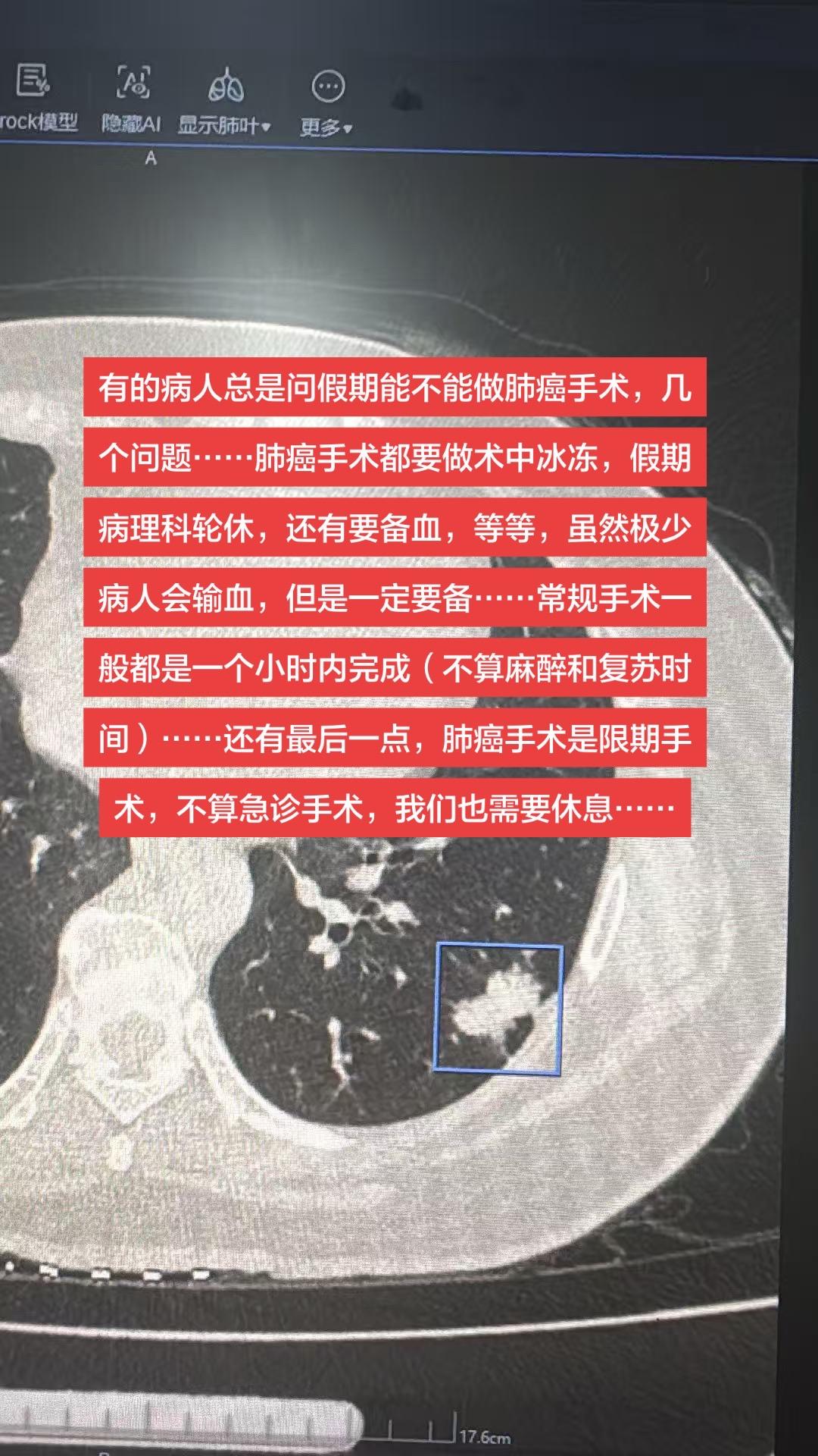 有的病人总是问假期能不能做肺癌手术，几个问题……肺癌手术都要做术中冰冻...