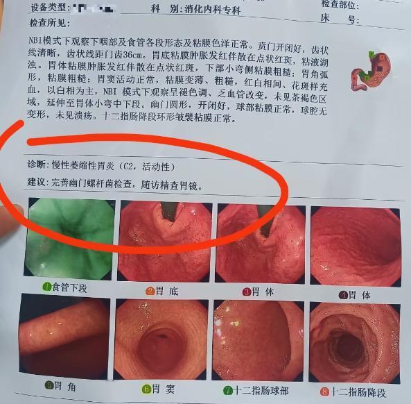 好好的胃为什么会变成萎缩性胃炎？慢性萎缩性胃炎是慢性胃炎的一种类型。“萎缩”并