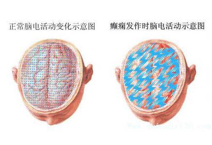 癫痫的早期征兆有哪些
