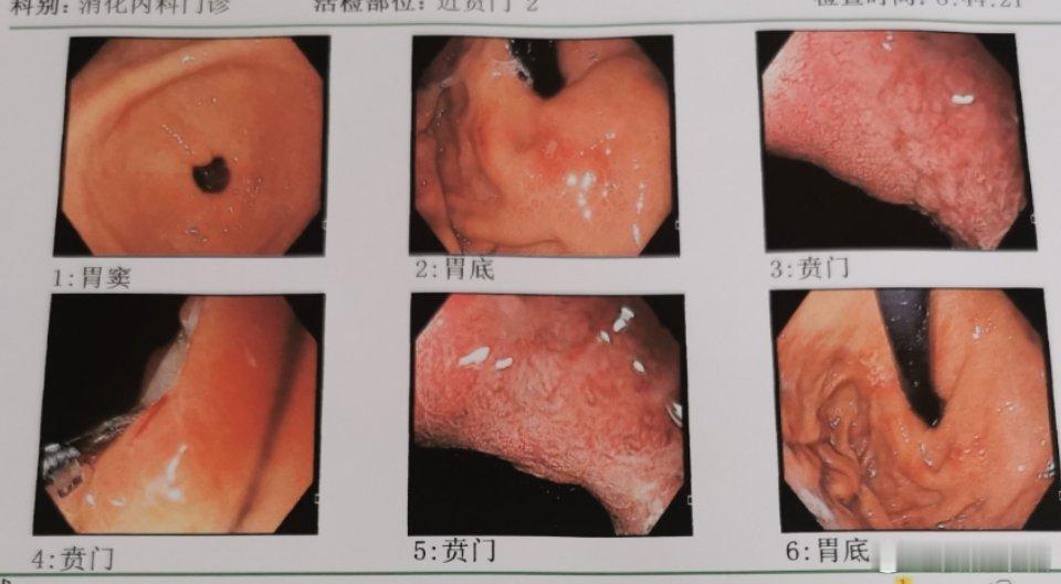 贲门及胃底溃疡：胃溃疡里面，胃底溃疡需要警惕，这个位置很难形成胃酸潴留，以及药物