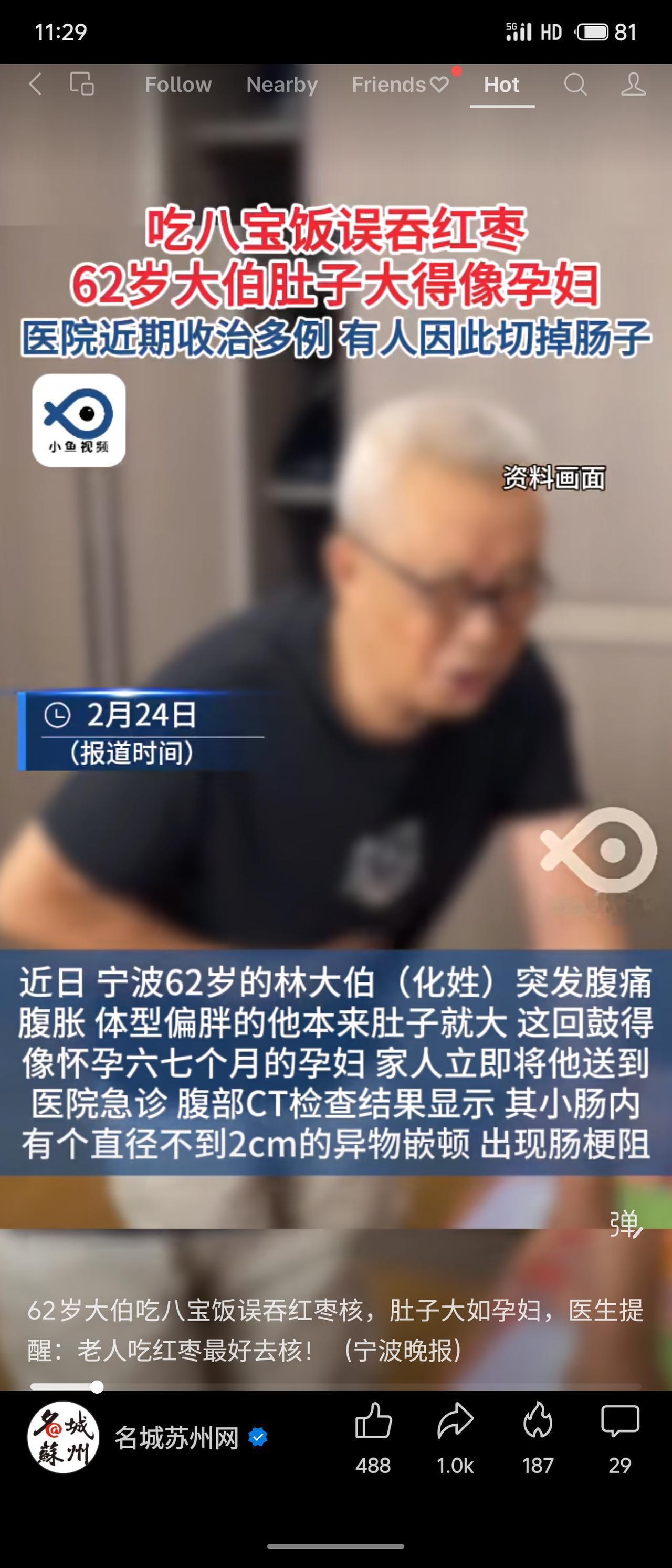 宁波62岁林大伯吃八宝饭误吞枣核，腹痛腹胀如孕，CT显示枣核卡在小肠致肠梗阻。因