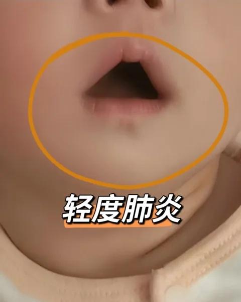 轻度肺炎，千万不要抱有侥幸心理⚠️轻度肺炎，千万不要抱有侥幸心理⚠️新手家长