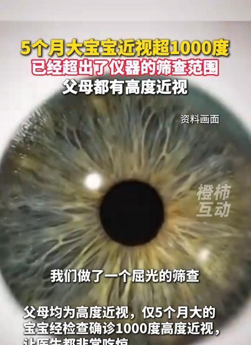 消息是6月2日传出来的：西安一对夫妻都是高度近视，他们5个月大的宝宝检查发现近视