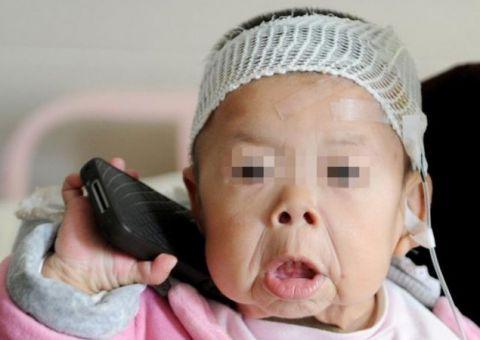 16个月女孩满脸皱纹、皮肤下垂, 就像80岁老太太