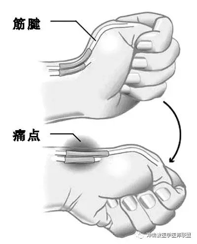 体外冲击波最安全肌肉骨骼疼痛新疗法
