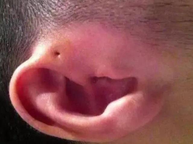 满月宝宝耳朵上有小孔还有异味, 妈妈的做法让医生大喊: 太无知