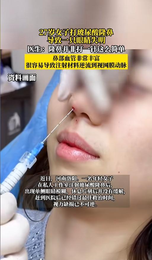 “太吓人了！”近日，河南洛阳，一位27岁女子在私人工作室进行了隆鼻。打完一针后，