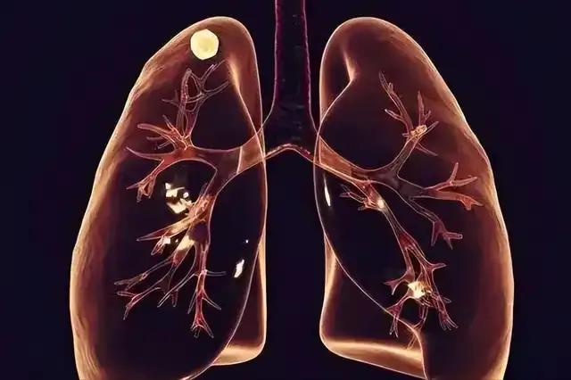 肺病两大祸根，怎么恢复快？一、肺有寒典型表现就是咳白痰、痰质稀薄，还常伴