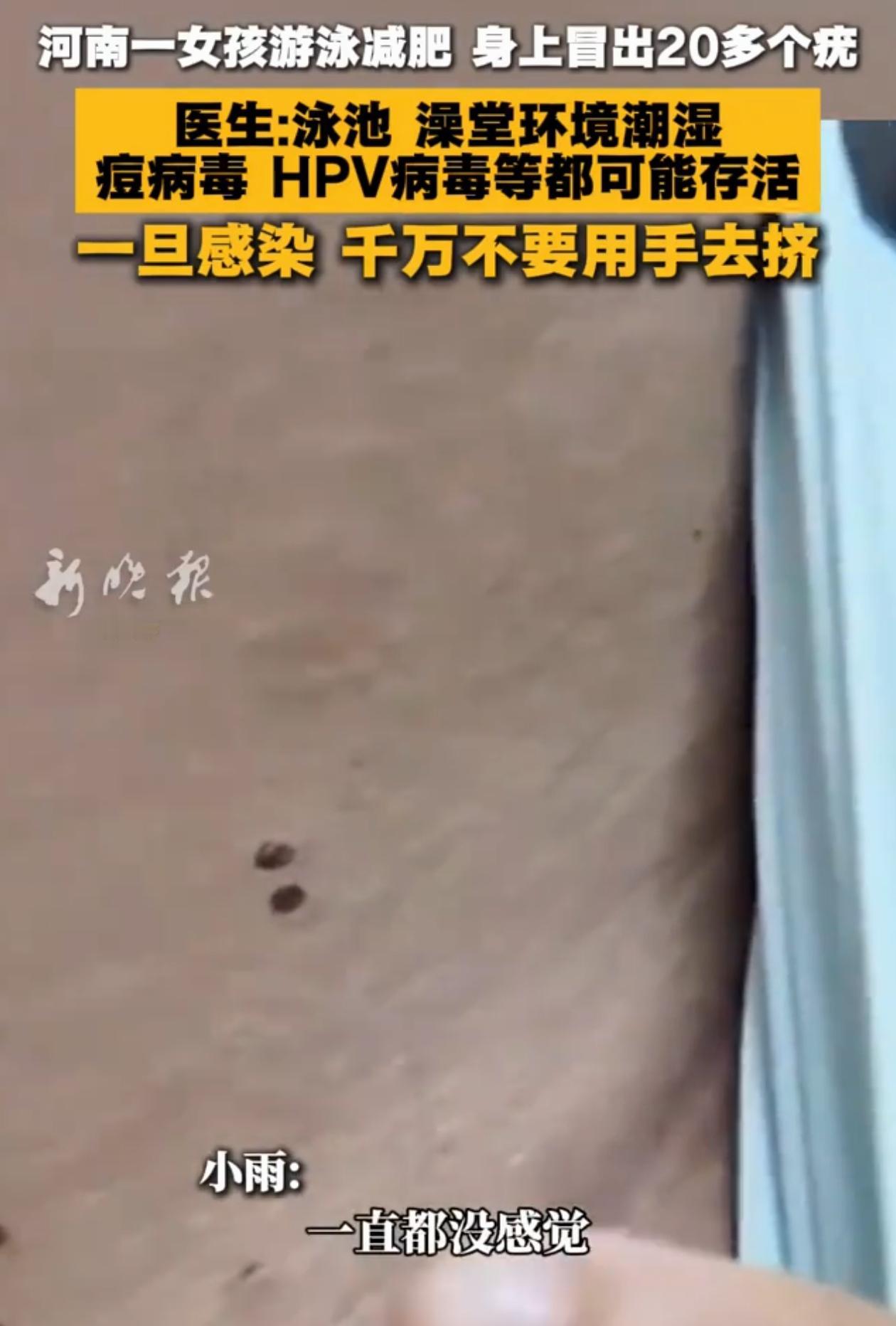 “这游泳池得多脏啊！”河南，女孩想着暑假去游泳减肥，可几天后却发现自己身上、胳膊