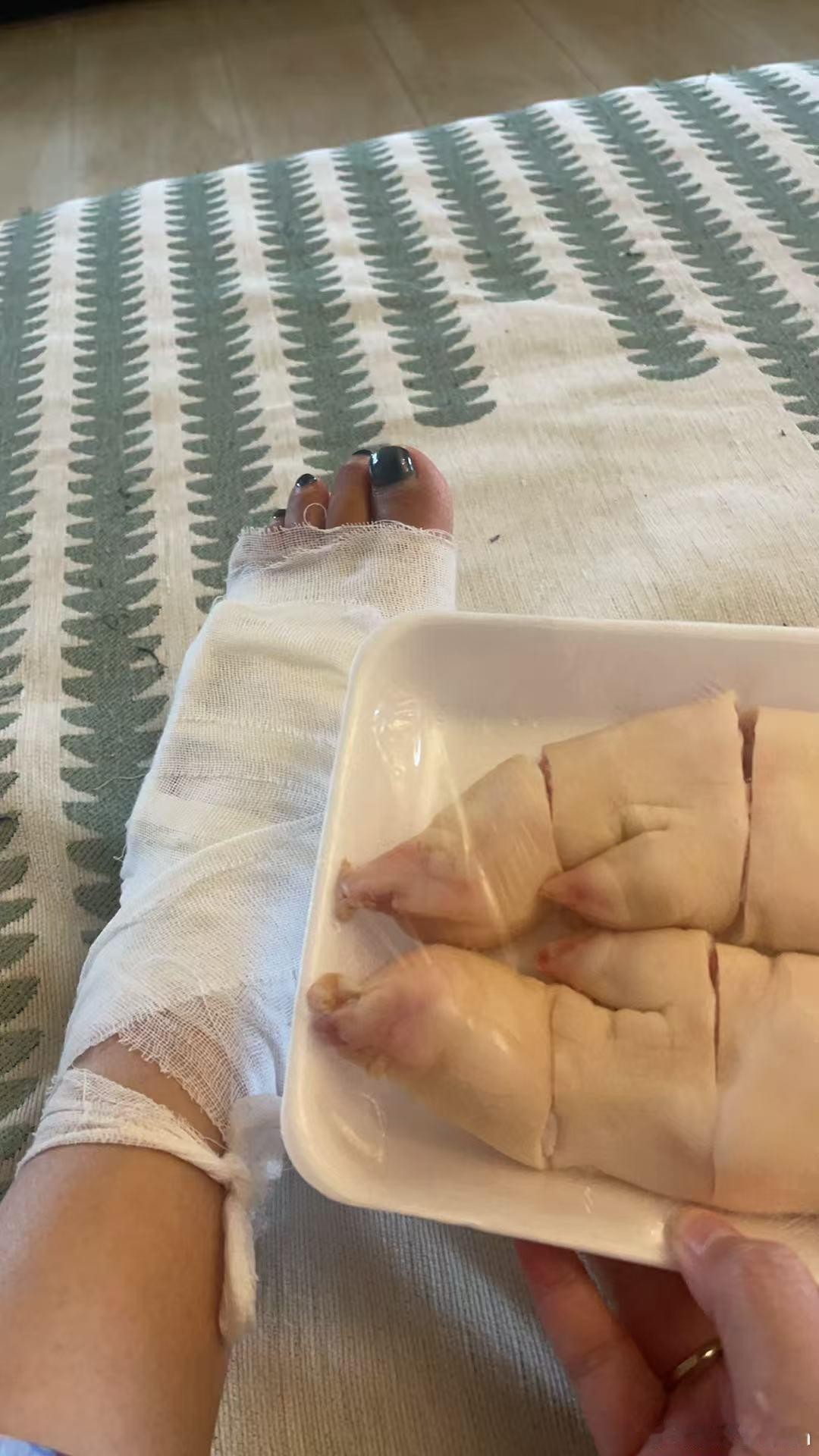 同事骨折了，上门看望，主打一个以形补形！看望病号​​​