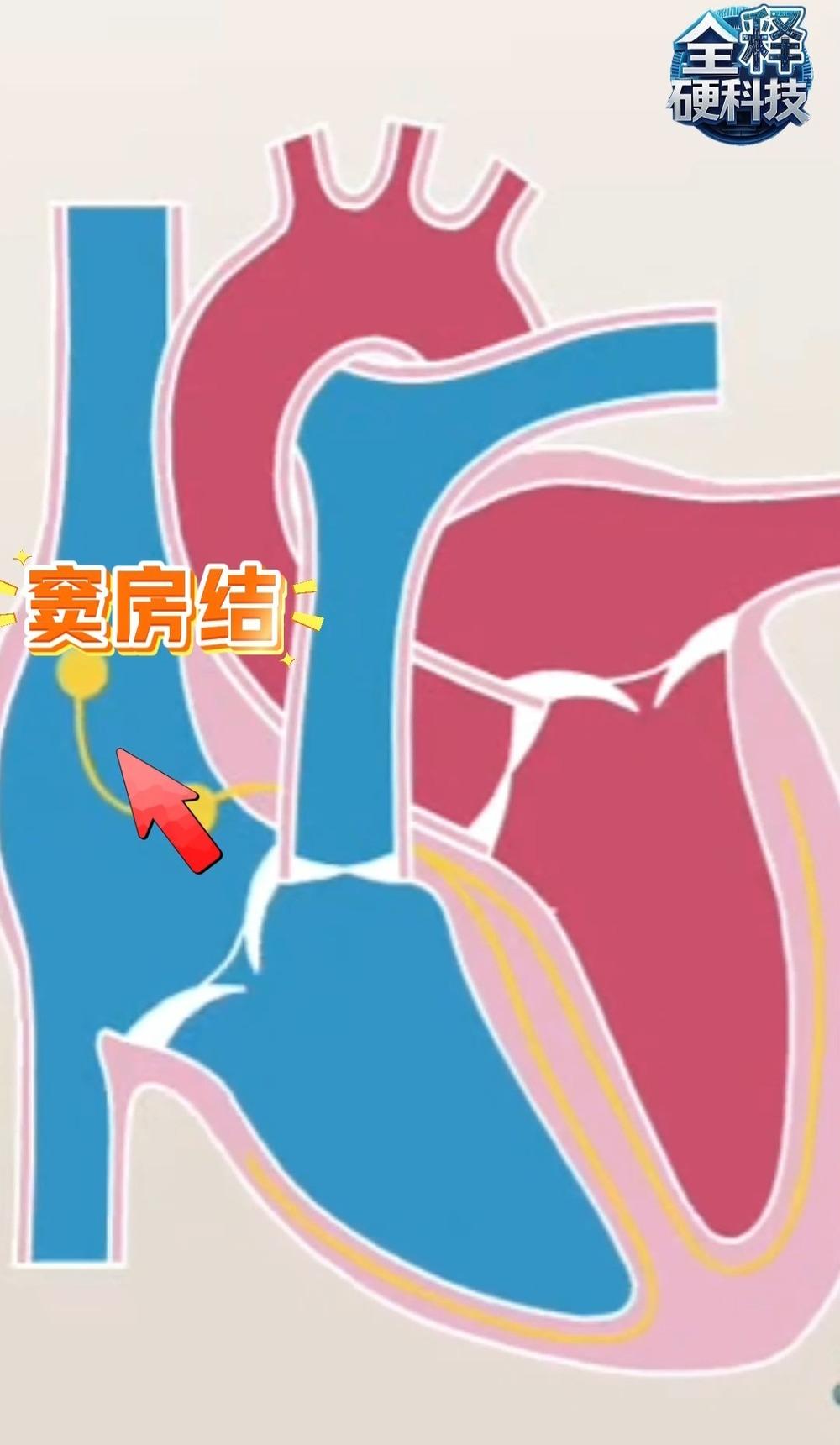 ✨告别电池！中国造出“活体心脏起搏器”：用自身细胞让心跳“永动”❤️🔥心脏