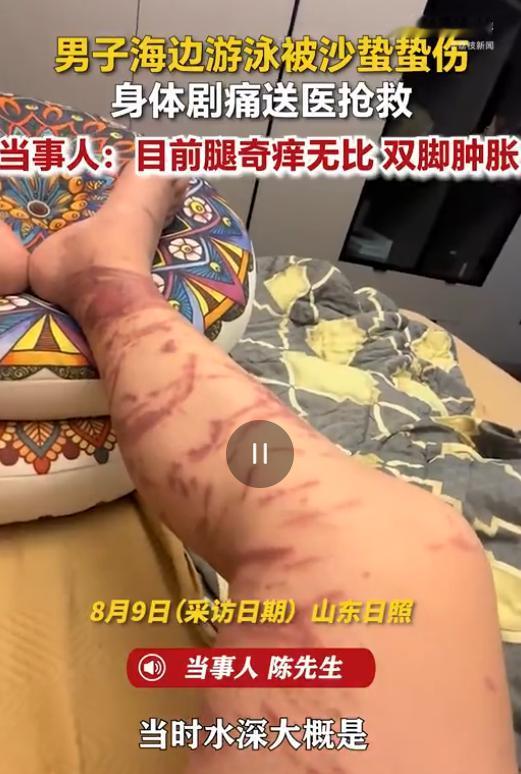 山东日照，男子下海游泳，万万没想到到在浅水区突然遭遇了水下“隐形杀手”，当场像触