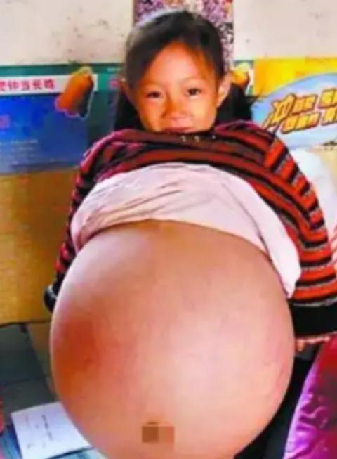 2010年，山西4岁女孩胡云星，肚子超大鼓胀得像孕妇。医生预言活不过三个月，就在