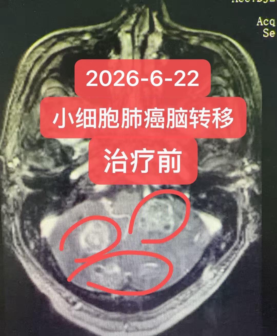 小细胞肺癌脑转移一例。患者为74岁，男性，临床分期为广泛期（IV期）右...