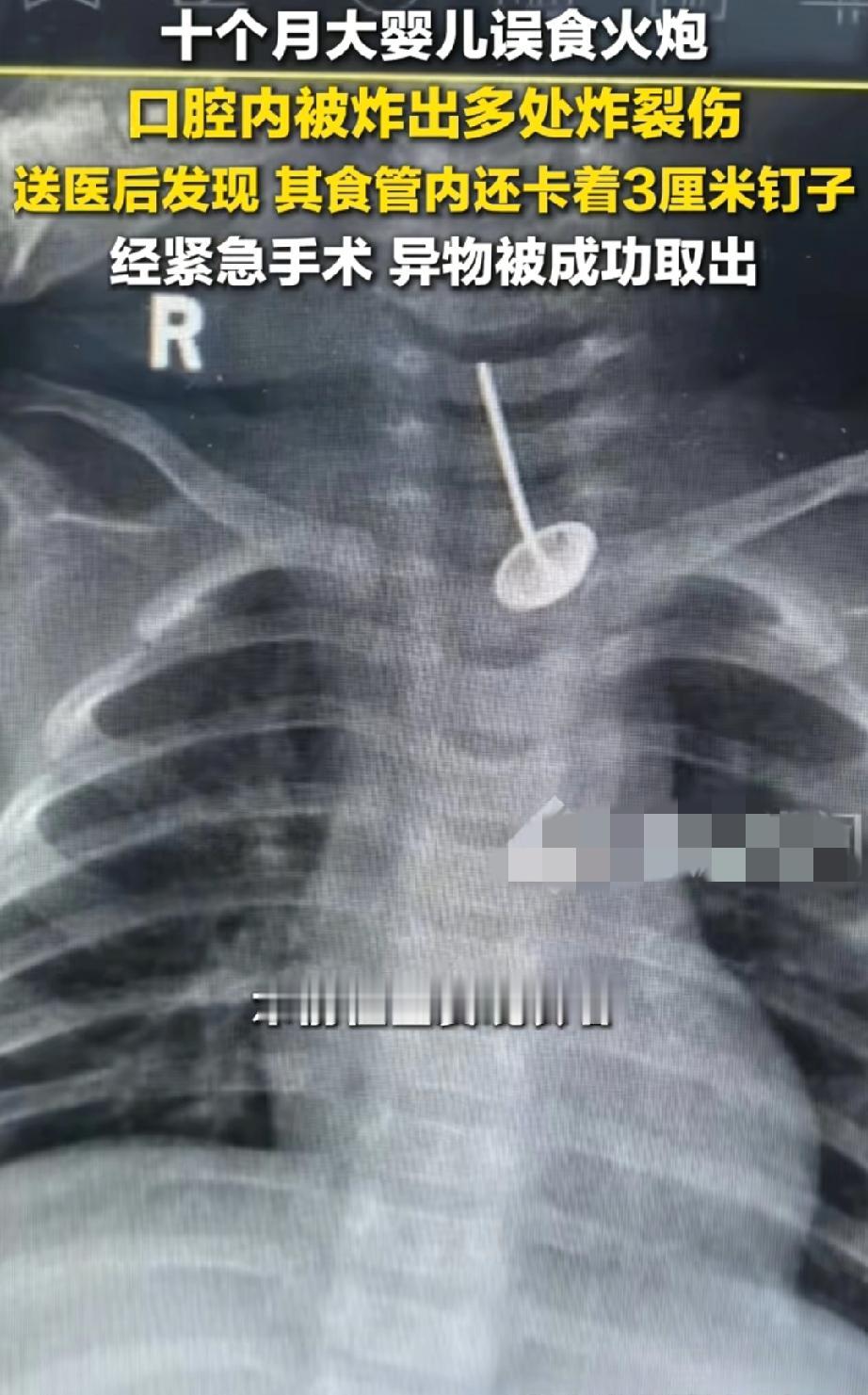 10个月宝宝误食摔炮、钉子，真的是意外吗？一个10个月大的婴儿误食摔炮炸伤口