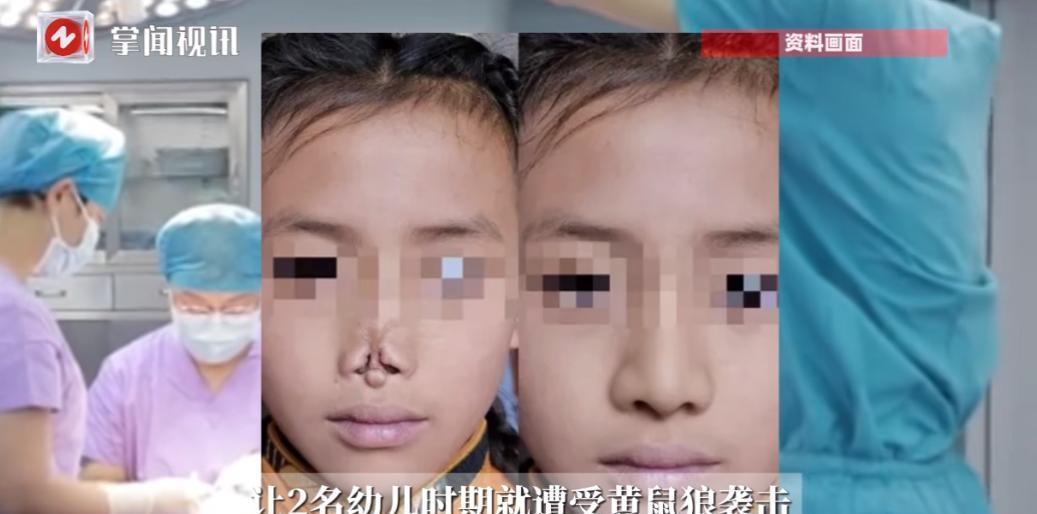“这才是真正的专家！”四川甘孜，两牧民孩子，在幼年都被黄鼠狼咬掉鼻子，导致多年来