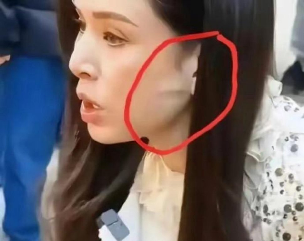搞不懂了，李若彤不是没有医美过吗？这耳前凸起的一条线是啥