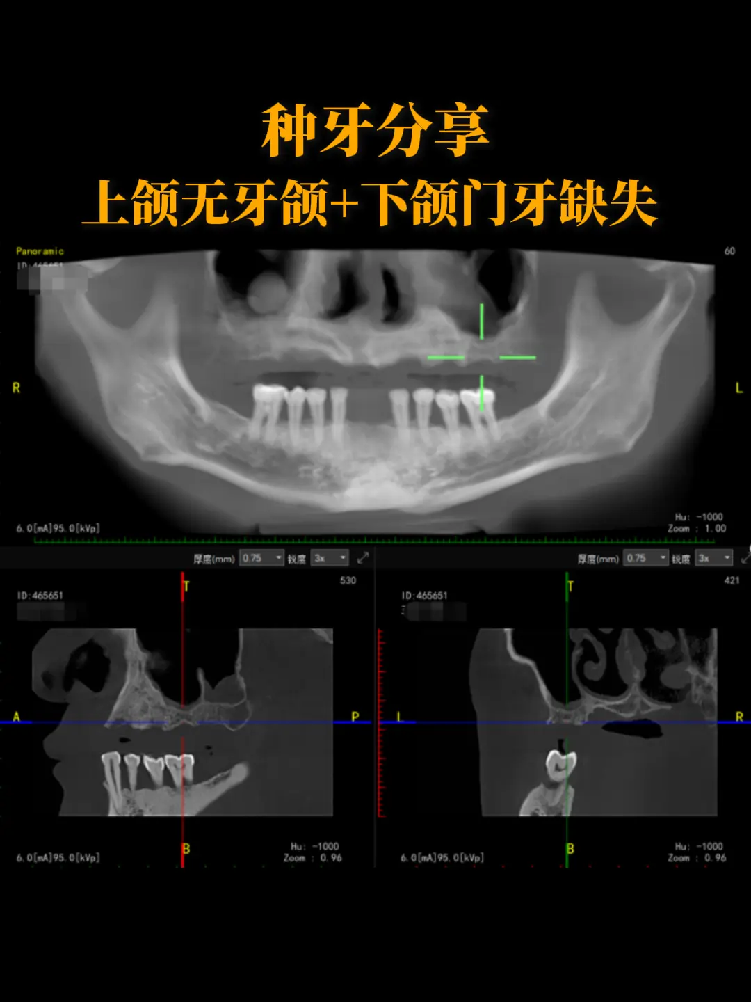 【种牙分享】上颌无牙颌+下颌门牙缺失。这是一位41岁男性患者，他的上下...