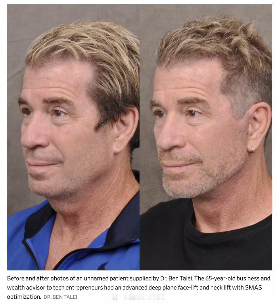 为了不被裁员硅谷科技男扎堆做医美容貌焦虑的风吹到了硅谷“科技男”的身上，他们正在