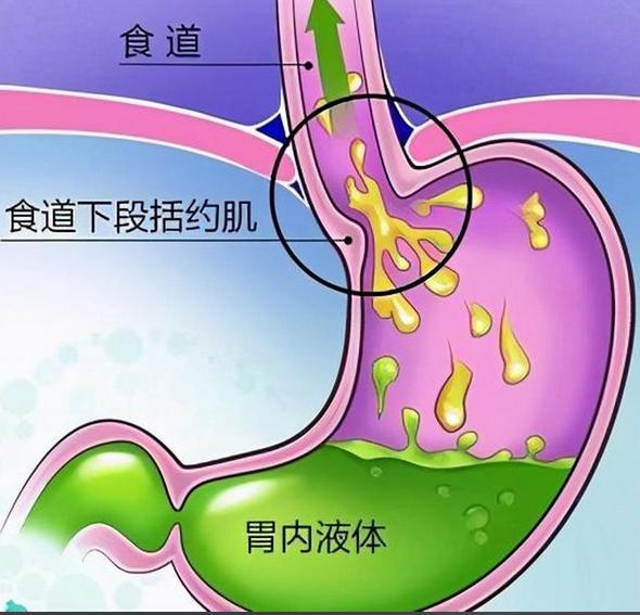 反流性胃炎根源在胃气上逆!一张流传多年的小方,仅2味药,降逆就是养胃,从口到