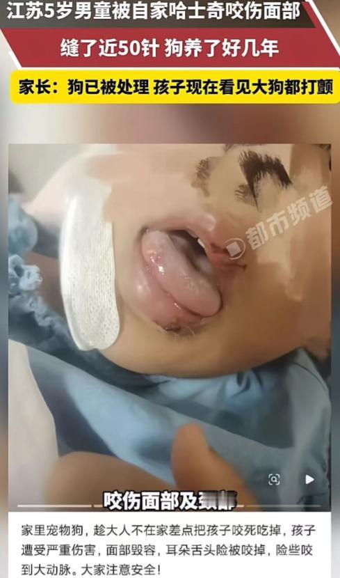 “这下养狗的都被干沉默了！”江苏，5岁男童被自家哈士奇咬伤面部，缝了近50针！孩