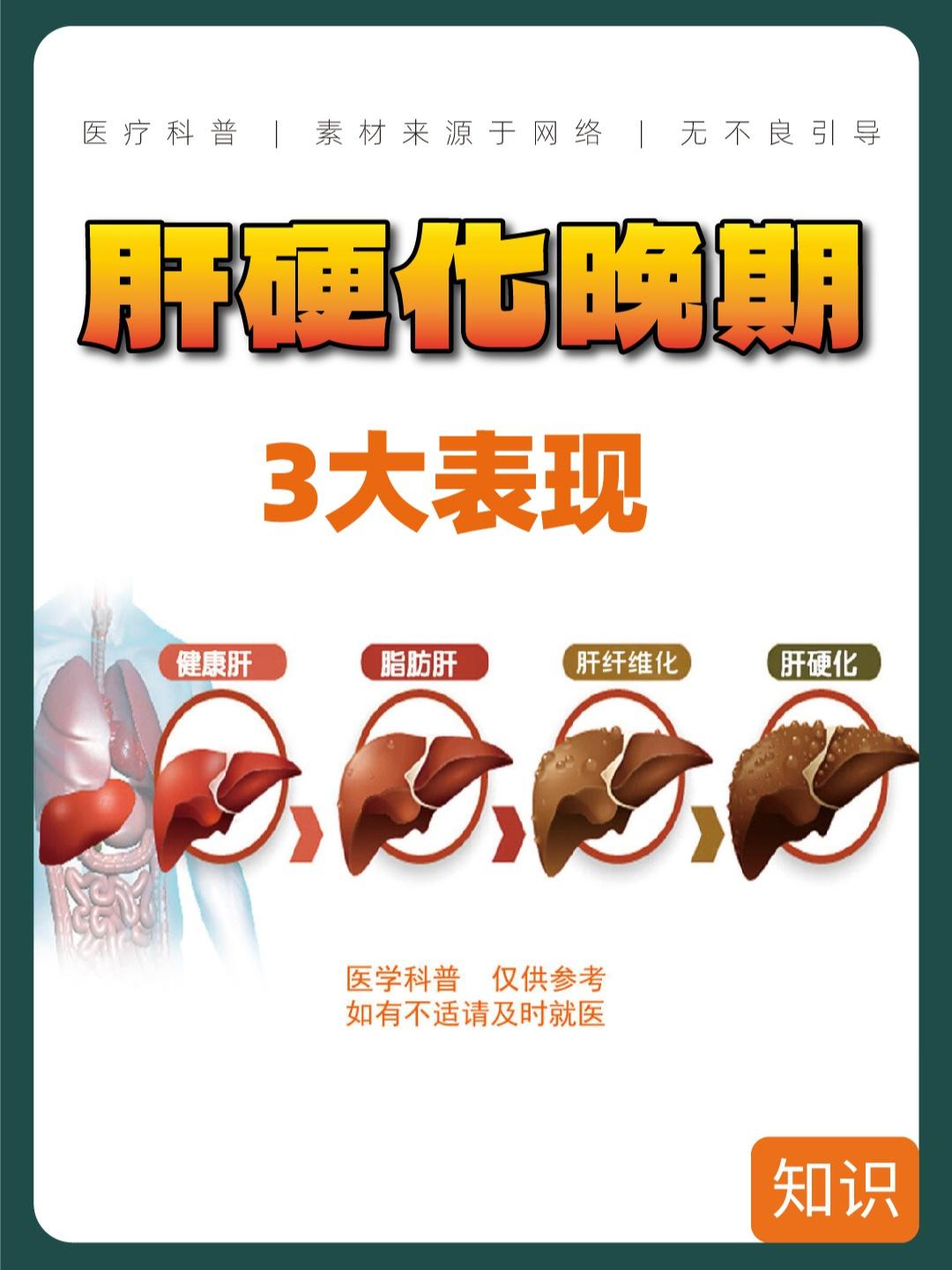 肝硬化晚期的三大表现。