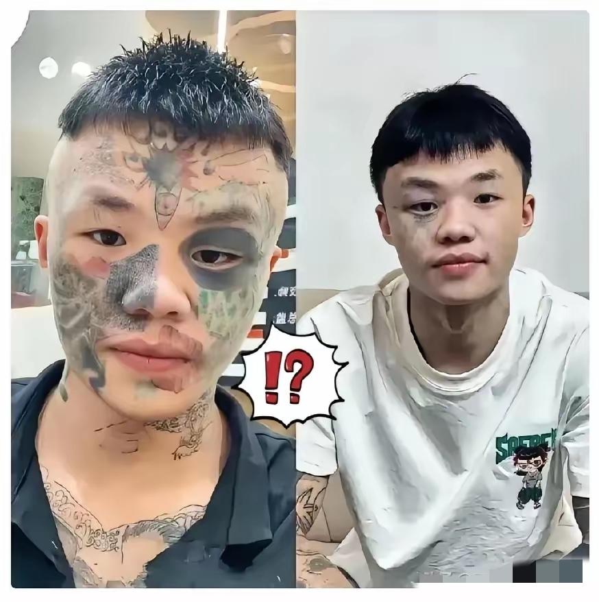 广东的夏朝勇快把纹身洗干净了！再熬两次激光，就能跟13岁时的“威风”彻底说再见，