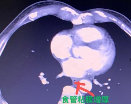 这个案例很有参考价值！一位63岁的患者，因为胸口发闷来过两次门诊。我给他做了胸部