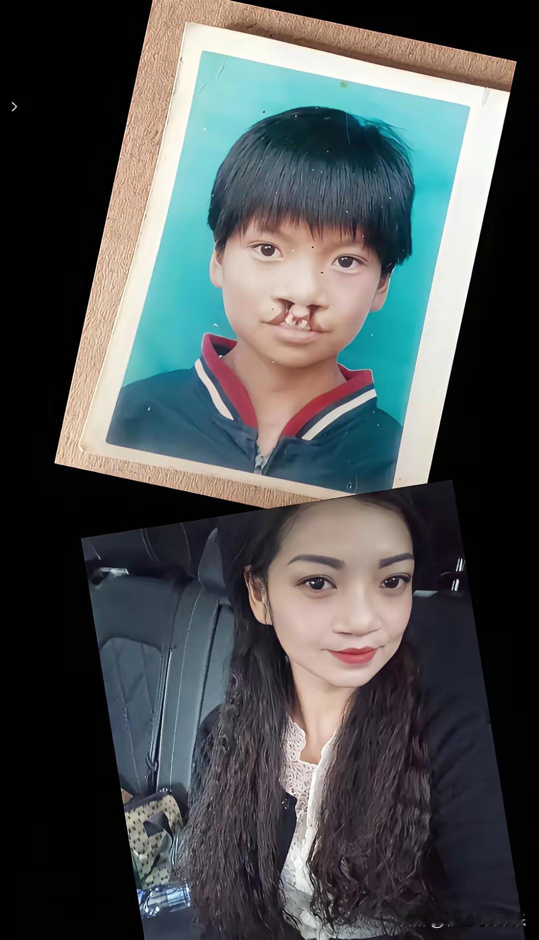 李亚鹏挺住，看着这16年来做手术恢复正常的孩子长大后的模样，我真的很想哭。唇