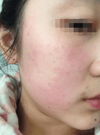 冬季湿疹复发, 简单方法轻松应对。