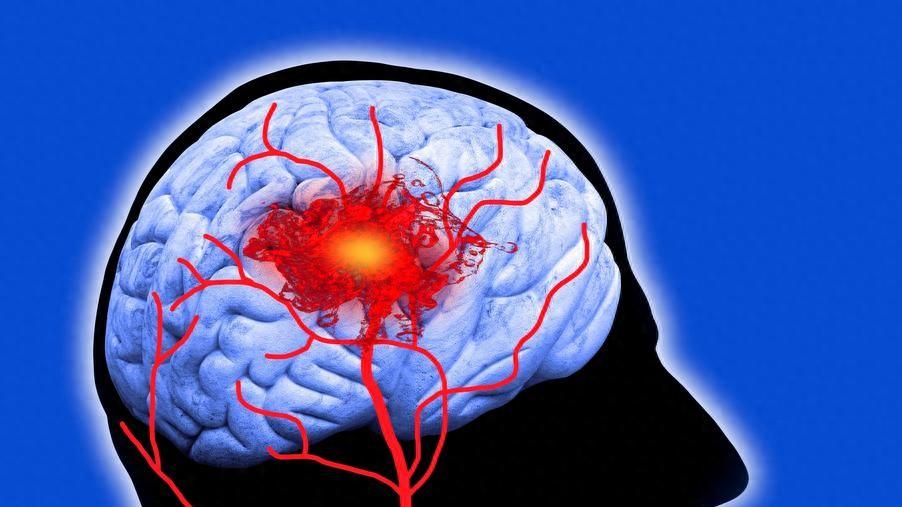 每延迟1分钟，大脑损失190万神经细胞！脑卒中黄金救治时间仅4.5小时