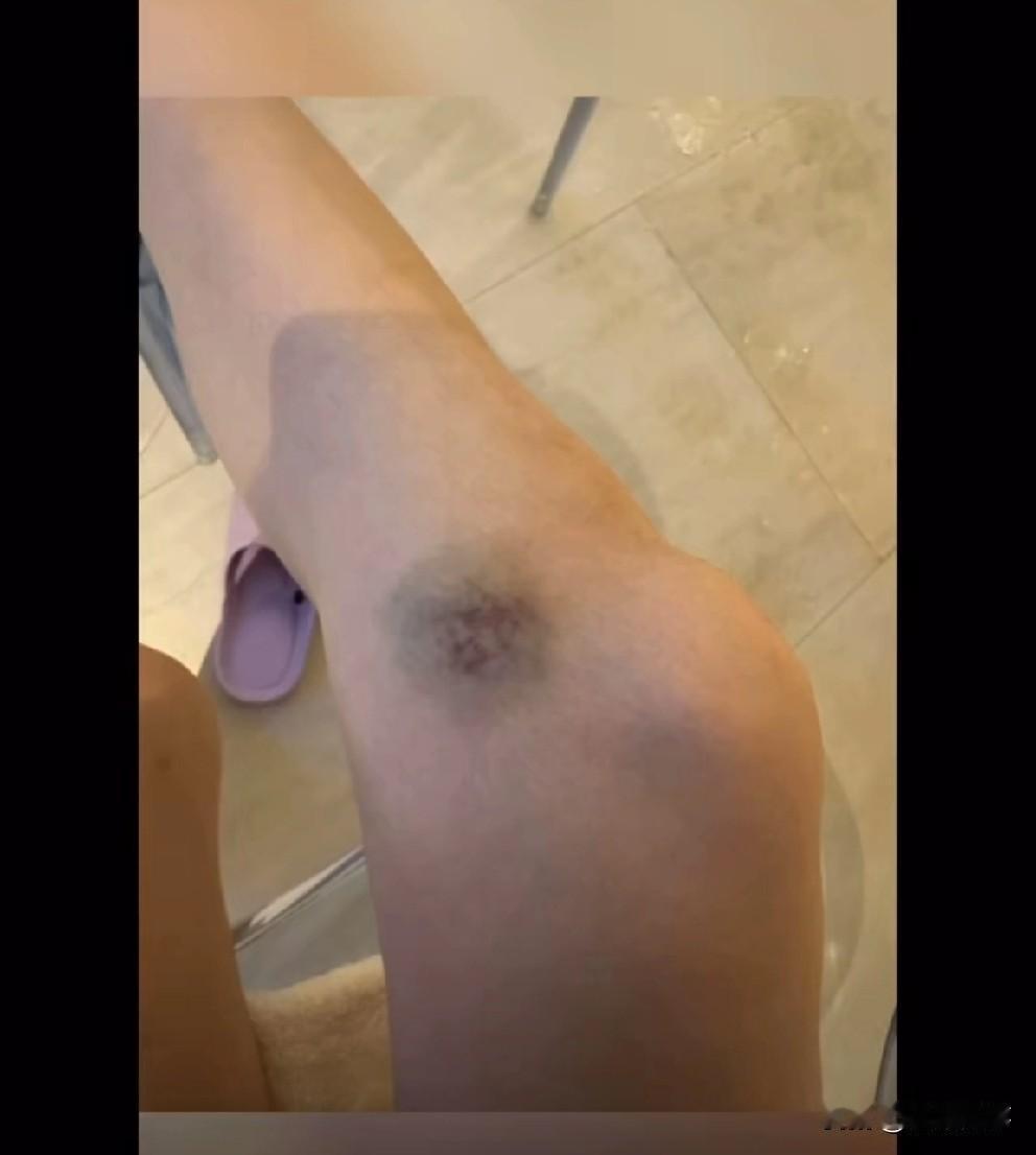 鼻孔窜血全是伤！白雨公开老狗家暴监控录像，重拳打倒在地。