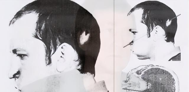 1978年，苏联一位物理学家，不小心被高辐射的粒子光速击穿脑袋。但随后却发生了奇