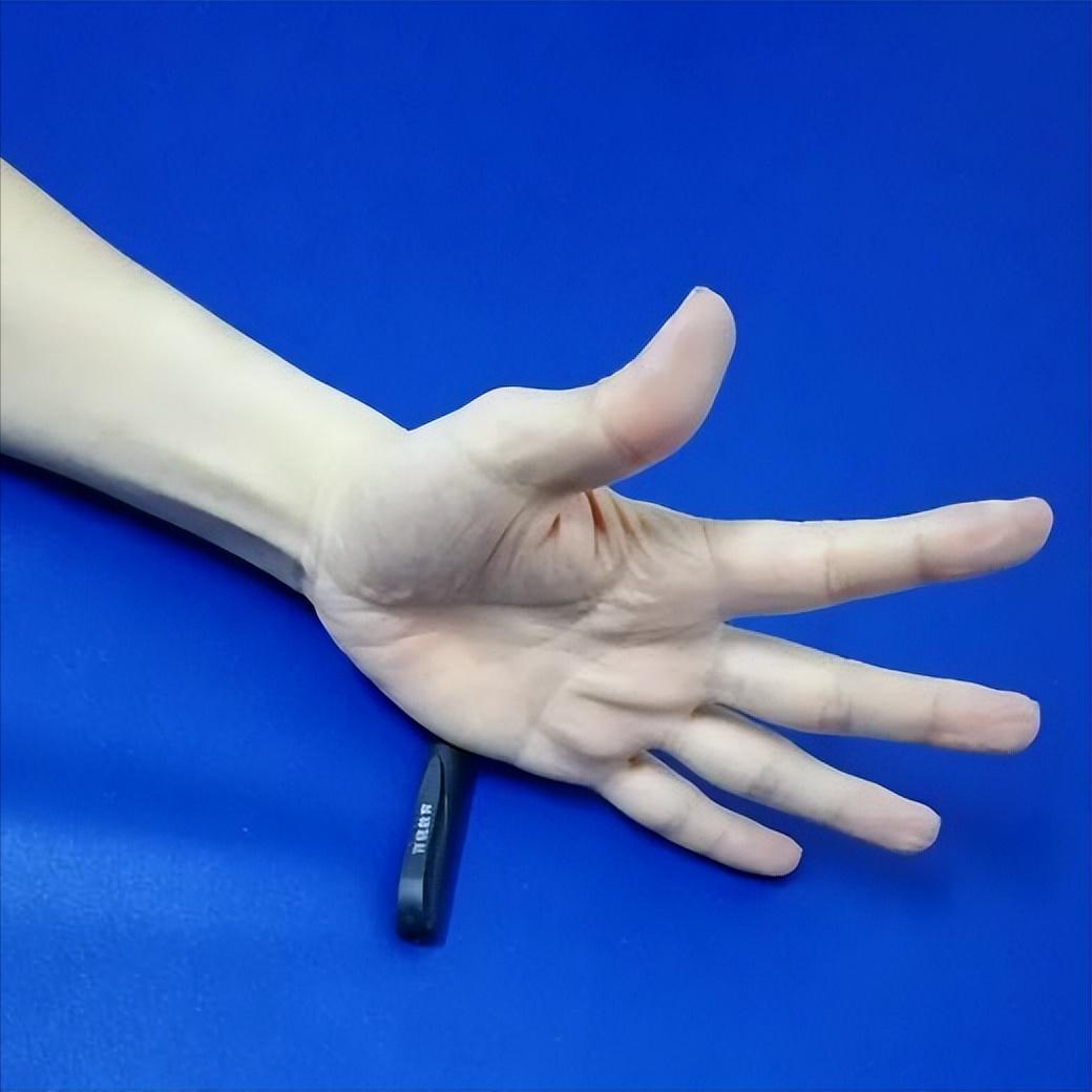 偏瘫最大的“拦路虎”——竟然是精细活动！ 偏瘫康复有一个常见的现象：锻炼过一