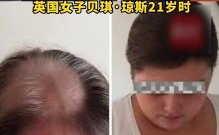 “作孽！”一女子21岁时，被确诊脑癌晚期。她坚持化疗11年后，竟得知自己压根没患