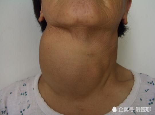 哪类甲状腺疾病会导致脖子粗大?