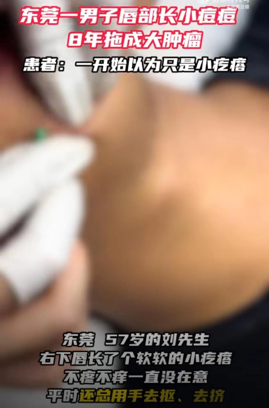 简直是血的教训！东莞，一57岁男子，8年前唇上长了个不痛不痒的小疙瘩，他以为只是