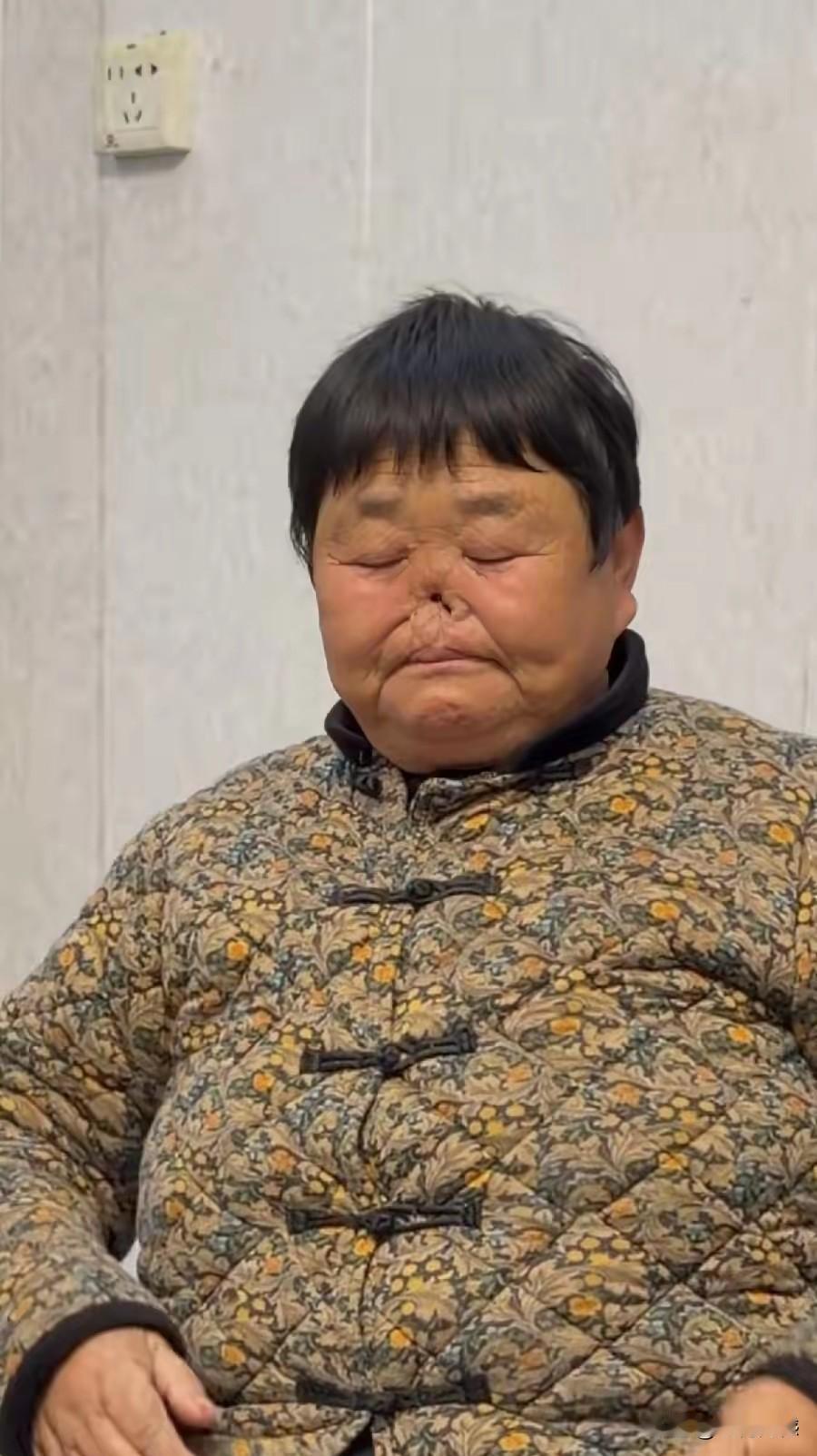 据说这位大姐的鼻子是在小时候被耗子咬掉的，小时候家里穷，住的房间里耗子特别多，大