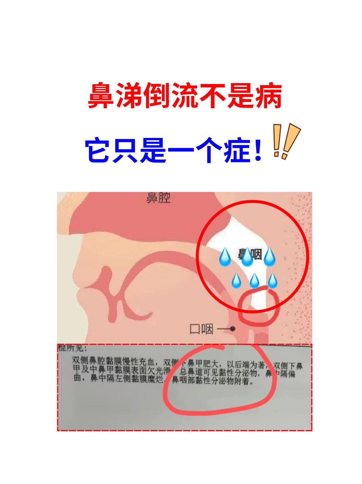鼻涕倒流不是病，它只是一个症！ 很多人鼻炎鼻涕倒流治不好，是因为没有搞清楚问